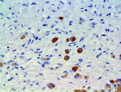 Brachyury Antibody Immunohistochemistry on a FFPE Chordoma Tissue